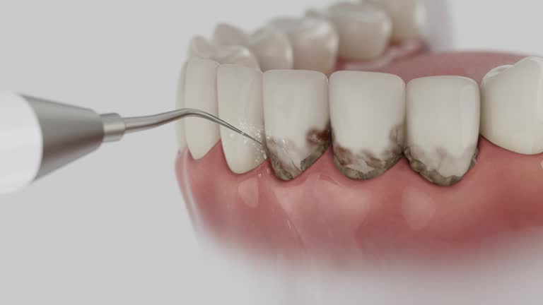 Trusted Wisdom Tooth Removal service in Rossville, GA - Dentist Open Now